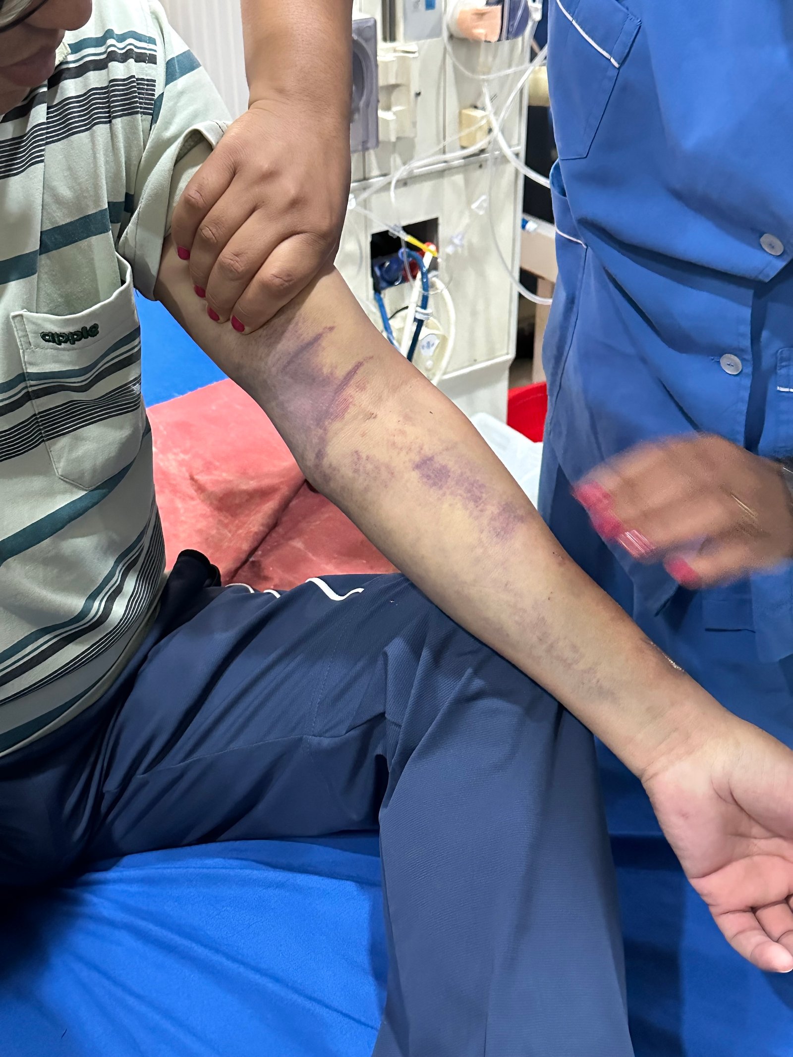 A nurse holds the arm of a man with many bruises from IVs
